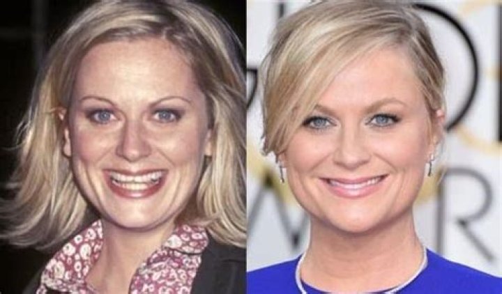 Amy Poehler Plastic Surgery Before and After Botox Injections
